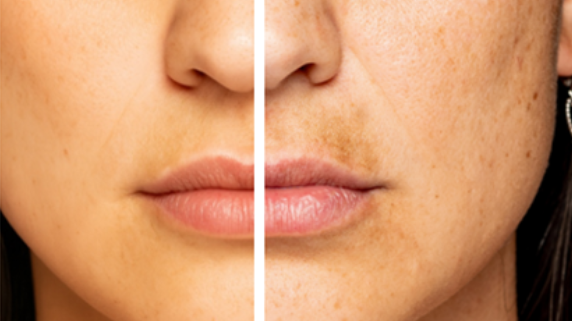 dark spots before after