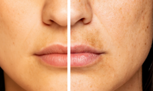 dark spots before after